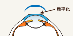 （3）翌朝レンズをはずすと、角膜がレンズの形状に変形し、視力が回復します。