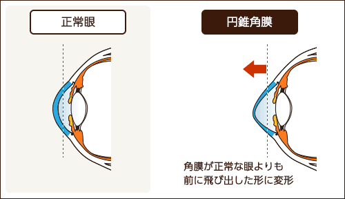 円錐角膜と正常眼