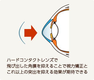 ハードコンタクトレンズによる円錐角膜の治療