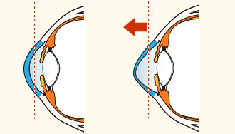 円錐角膜治療