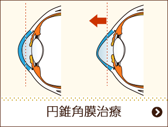 円錐角膜治療